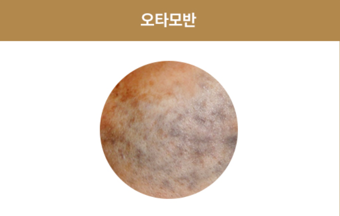 강남오타모반? 거뭇거뭇한 얼굴 치료를 원하신다면 관련 이미지 3