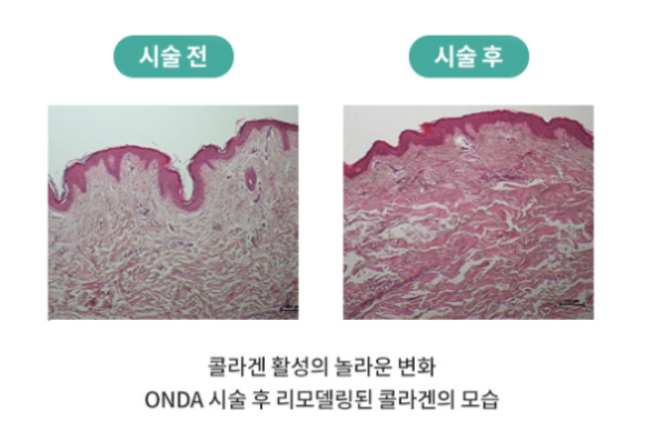 선릉역 온다리프팅 전후 효과와 차이 비교 관련 이미지 4