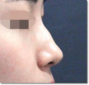 강남하이코 낮은 콧대가 고민이라면? 관련 이미지 6