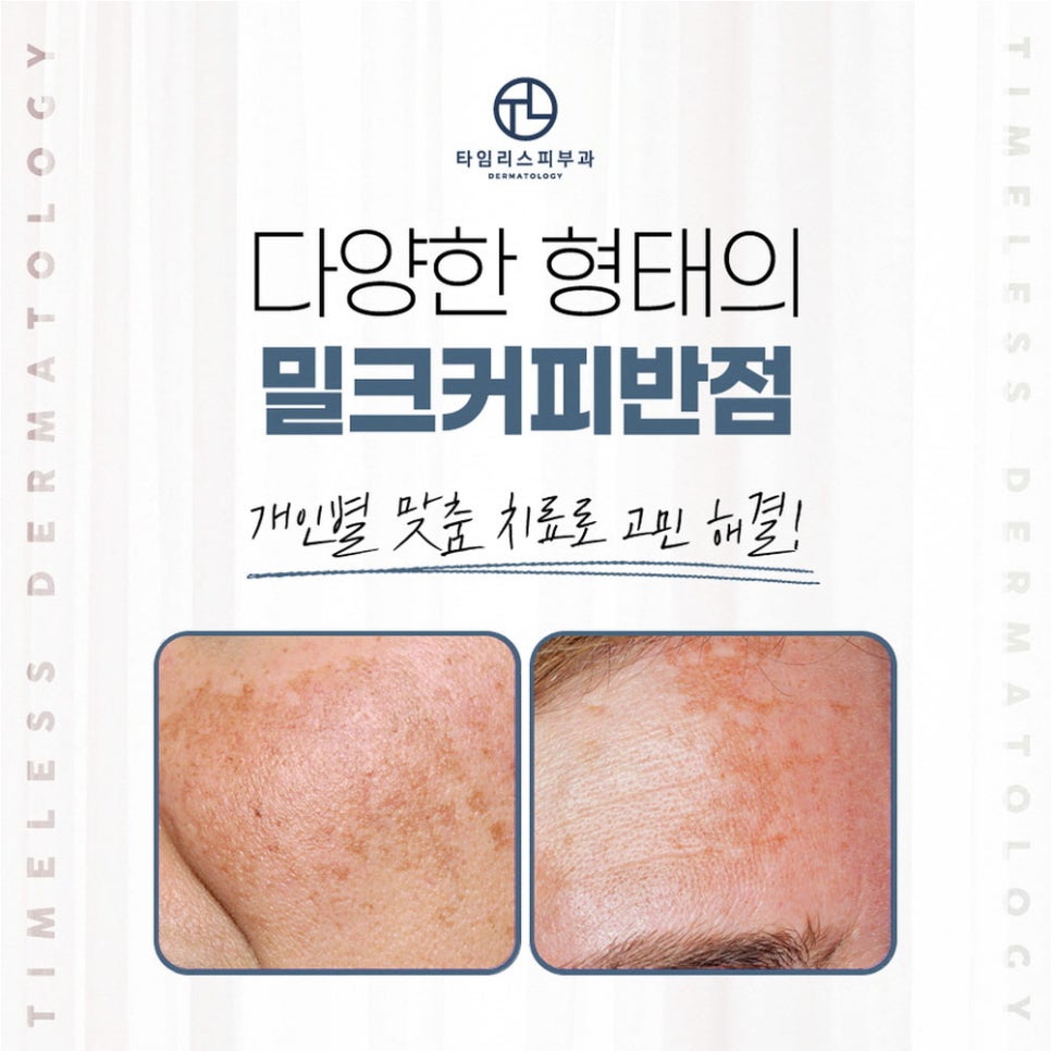 아현역피부과 색소질환 고민, 말끔히 해결! 관련 이미지 5