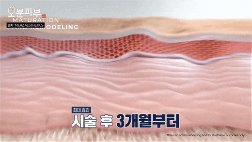 Dermatology Clinic Near Mapo Station: Ultherapy Effects, Side Effects, and Duration <Complete Overview> image 6