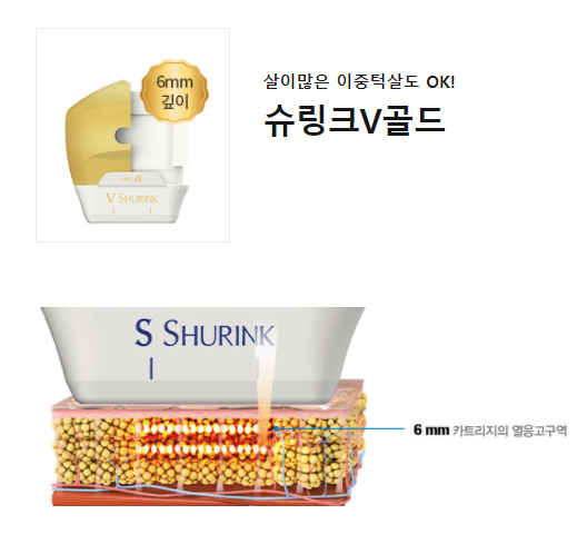 이중턱 없애는법 원인 슈링크리프팅효과 어떨까? 관련 이미지 5
