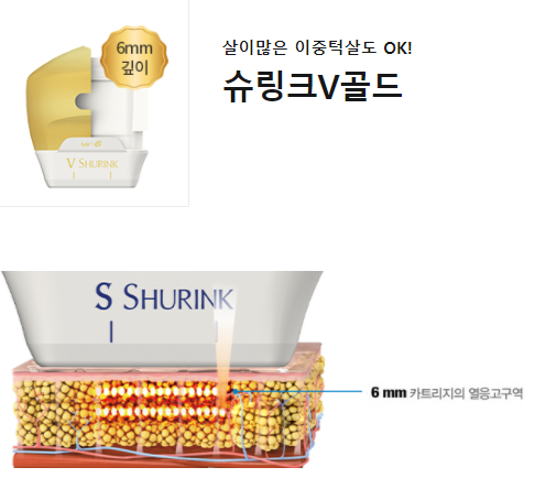 슈링크리프팅효과 갸름한 턱선 골드슈링크리프팅은 어떨까요? 관련 이미지 5