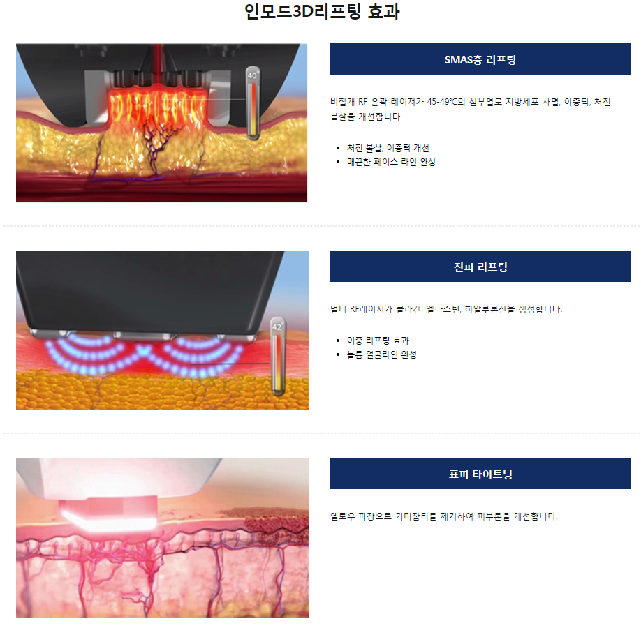 인모드리프팅 마포타임리스피부과에서 브이라인만들기 관련 이미지 5