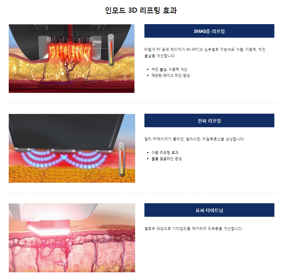 인모드리프팅효과 타임리스에서 이중턱 관리하기 관련 이미지 6