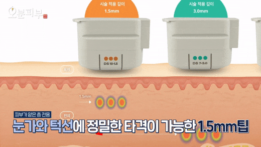 Dermatology Clinic Near Mapo Station: Ultherapy Effects, Side Effects, and Duration <Complete Overview> image 8