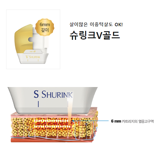 마포피부과 슈링크리프팅효과 궁금하면 타임리스 관련 이미지 4