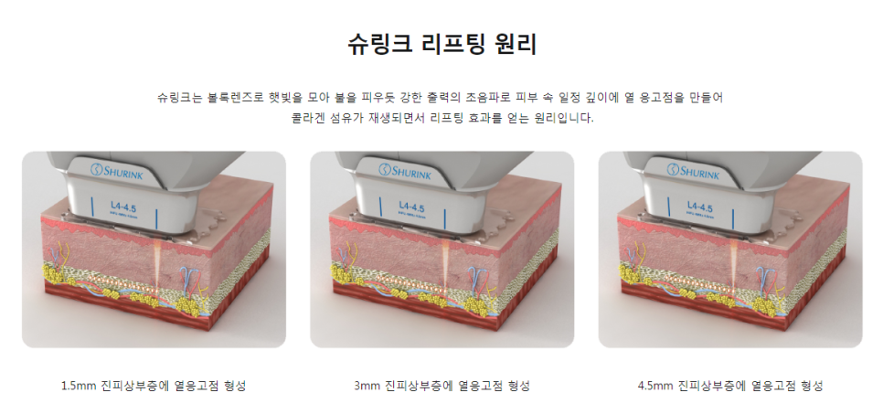 이대슈링크리프팅가격 궁금하다면 타임리스마포에서 관련 이미지 4