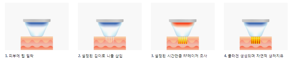 마포구 아현역 여드름흉터, 모공치료 피부과-시크릿RF레이저 관련 이미지 4