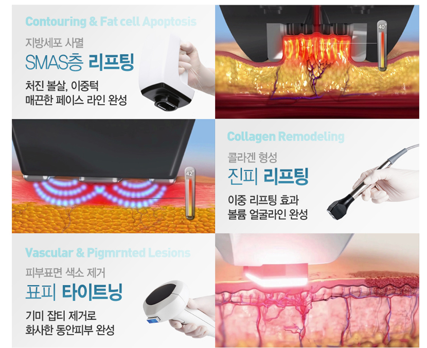 아현역피부과 타임리스의 인모드리프팅 관련 이미지 8