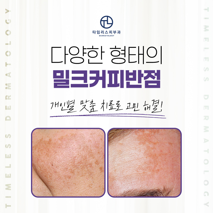 군집성흑자증 마포피부과에서 해결! 관련 이미지 4