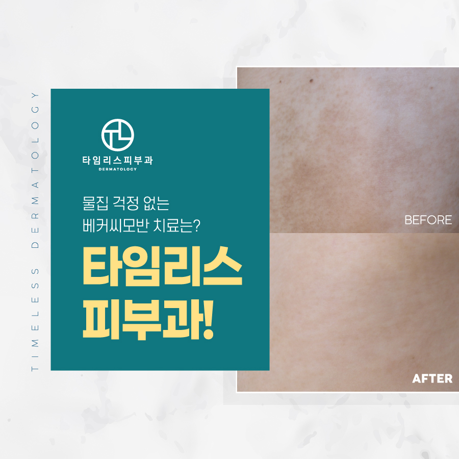 아현동피부과 혹시 난치성색소질환? 관련 이미지 4