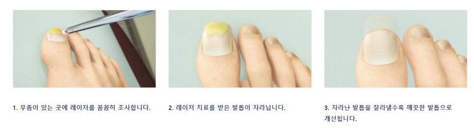 발톱무좀치료방법 구강청결제 식초 아직도 사용하시나요? 관련 이미지 6