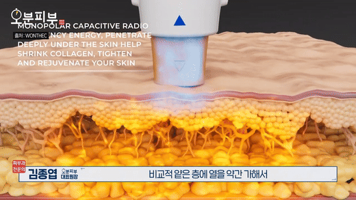 충정로피부과, 울써마지 시술 전 이것만 알면 실패 확률 줄어듭니다 관련 이미지 5
