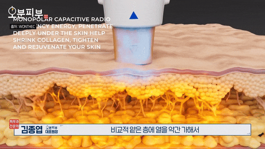 Gongdeok Dermatology Clinic: Essential Criteria to Check Before Choosing Between Ultherapy and Thermage image 5