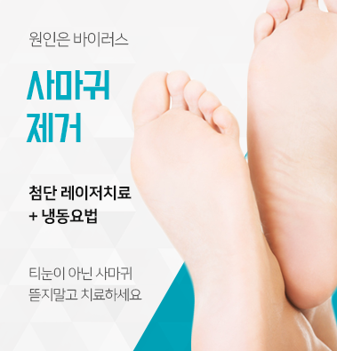 사마귀 티눈 차이 구별법 알아두세요 치료는 어떻게 관련 이미지 6