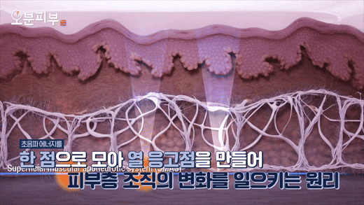 애오개역피부과, 울쎄라 리프팅 볼패임? 걱정된다면 관련 이미지 3