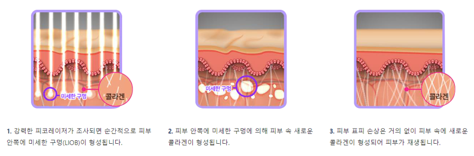 여드름흉터관리 여드름치료부터 손으로 하지말고 관리하세요 관련 이미지 5