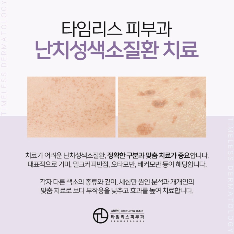 얼굴잡티제거비용, 방법이 궁금하다면? 관련 이미지 2