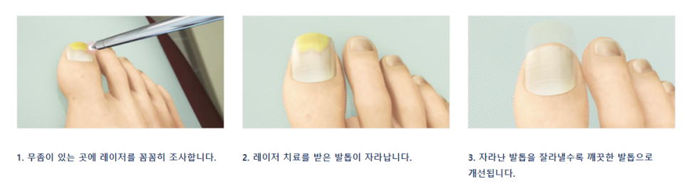 이대피부과 발톱무좀치료 비용 실비보험되는 타임리스로 관련 이미지 5
