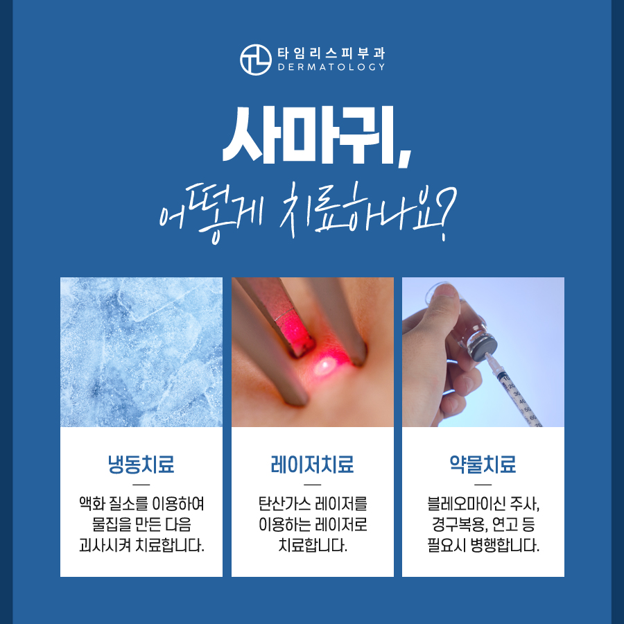 마포사마귀 레이저 치료 가능할까 관련 이미지 5