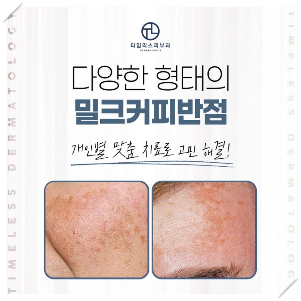 아현역피부과 색소질환이 생기는 원인 관련 이미지 5