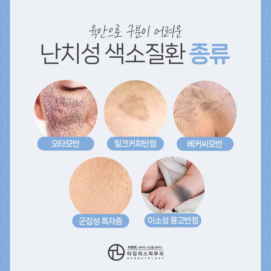 색소치료피부과에서 올바른 치료를 관련 이미지 4