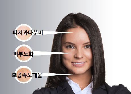 모공줄이는방법 피부과 모공축소레이저 효과 있나요? 관련 이미지 1