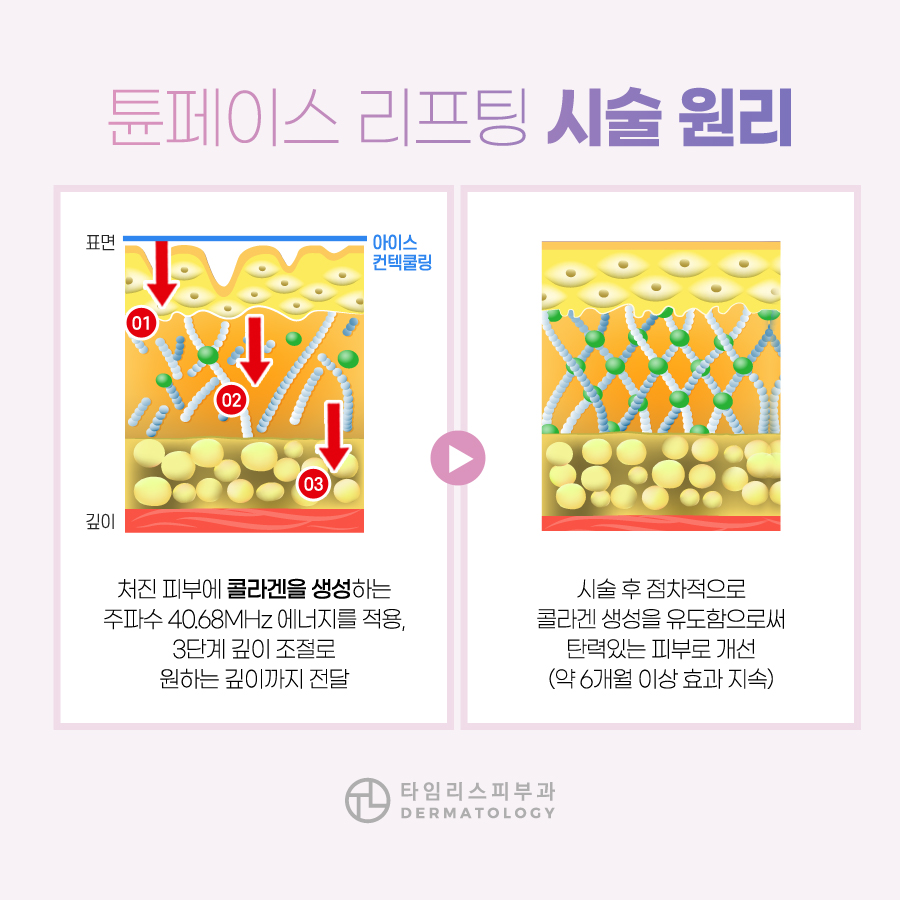 마포피부과 리프팅 주름을 개선하는 관련 이미지 3