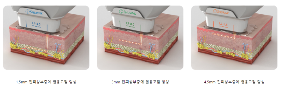 아현역피부과 처진 턱살 볼살 고민될 땐 타임리스마포 슈링크리프팅 관련 이미지 6