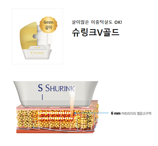 이대피부과 살많은 이중턱 타임리스의 골드 슈링크리프팅 관련 이미지 5