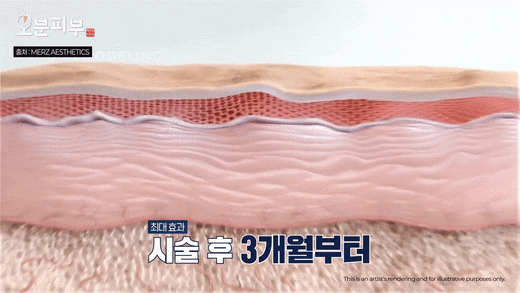 Bukahyeon-dong Dermatology Clinic: Ultherapy Effects, Side Effects, Pain, and Duration <Complete Guide> image 12