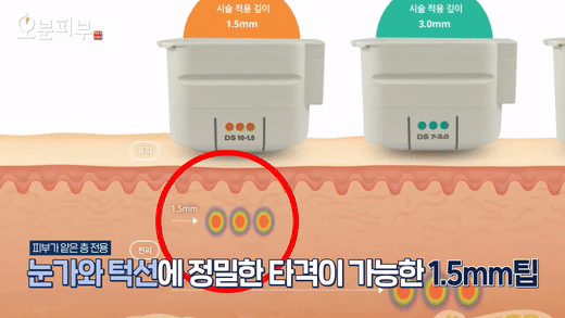 Bukahyeon-dong Dermatology Clinic: Ultherapy Effects, Side Effects, Pain, and Duration <Complete Guide> image 5