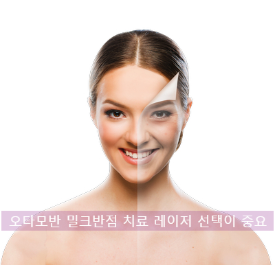 오타모반 밀크반점 치료 레이저 선택이 중요해요 관련 이미지 1