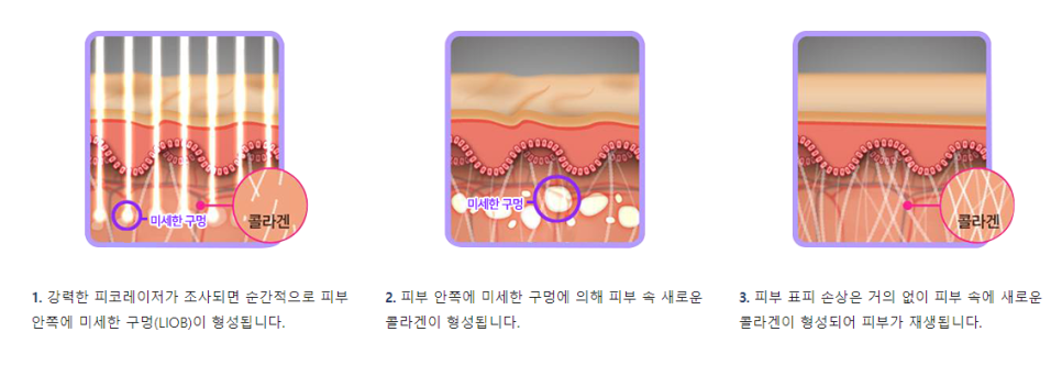 공덕피부과 여드름흉터 신경쓰일땐 타임리스에서 관련 이미지 6