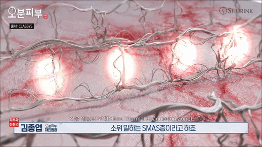 Gongdeok Dermatology Clinic: Essential Criteria to Check Before Choosing Between Ultherapy and Thermage image 4
