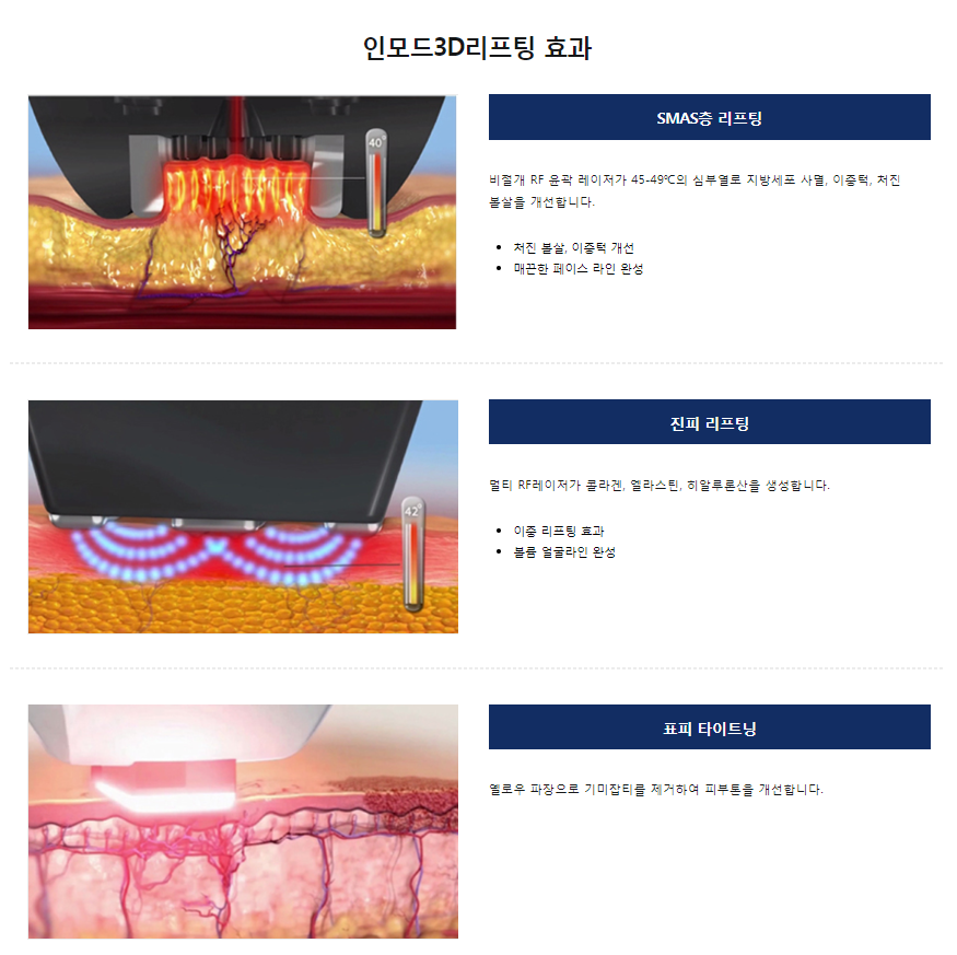 이중턱리프팅 이중턱 인모리프팅으로 세번당겨서 확실하게! 관련 이미지 5