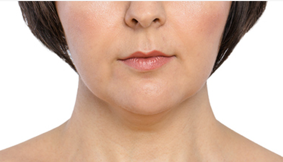 마포리프팅 잘하는곳 타임리스에서 처진살 당기기 관련 이미지 2