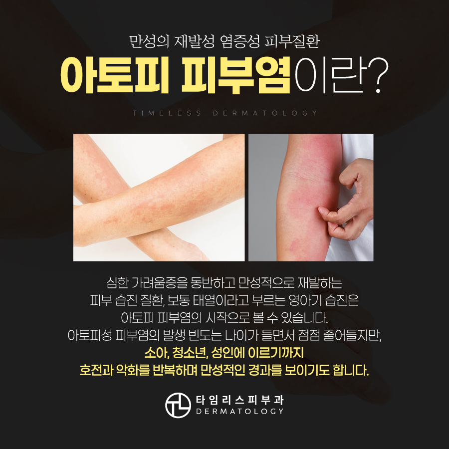 아토피피부염 맞춤 치료를 위해 원인부터 알아야 관련 이미지 2
