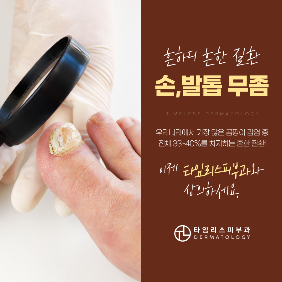 손발톱무좀 치료는 타임리스피부과! 관련 이미지 1