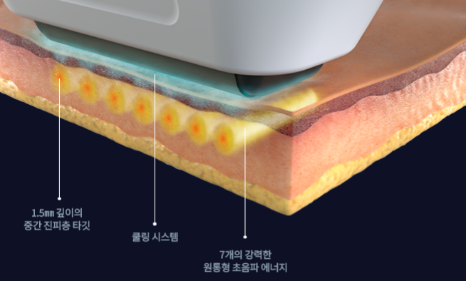 마포 리프팅 고민한다면 반드시 알아야 할 핵심 가이드 관련 이미지 7