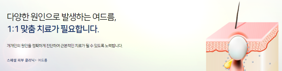 이대역피부과여드름 1:1맞춤치료로 매끈한피부 등극! 관련 이미지 2
