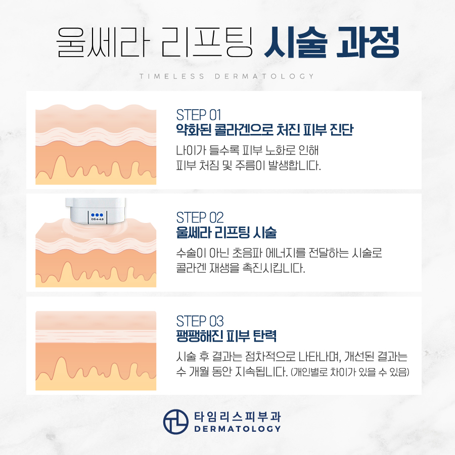 마포울쎄라 리프팅 직접 보며 원하는 깊이에 관련 이미지 4