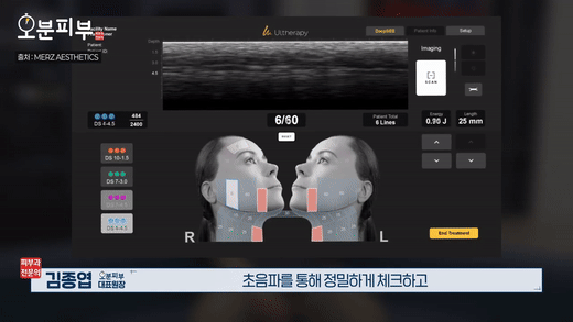Gongdeok Dermatology Clinic: Why Didn’t Ultherapy Work? An Honest Explanation image 3