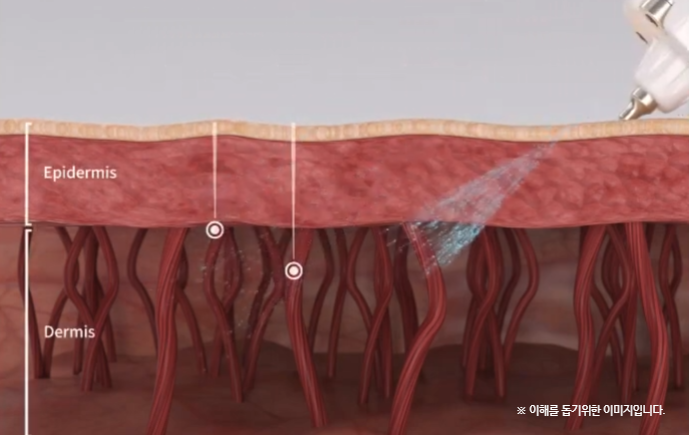 공덕큐어젯 모공과 흉터를 함께 본다면 관련 이미지 3