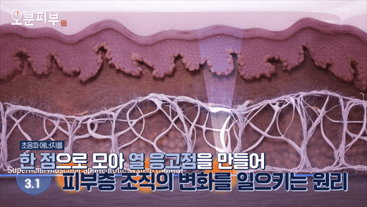 Seodaemun Station Dermatology Clinic Ultherapy Lifting? This Article Settles the Questions About Results and Shot Counts image 3