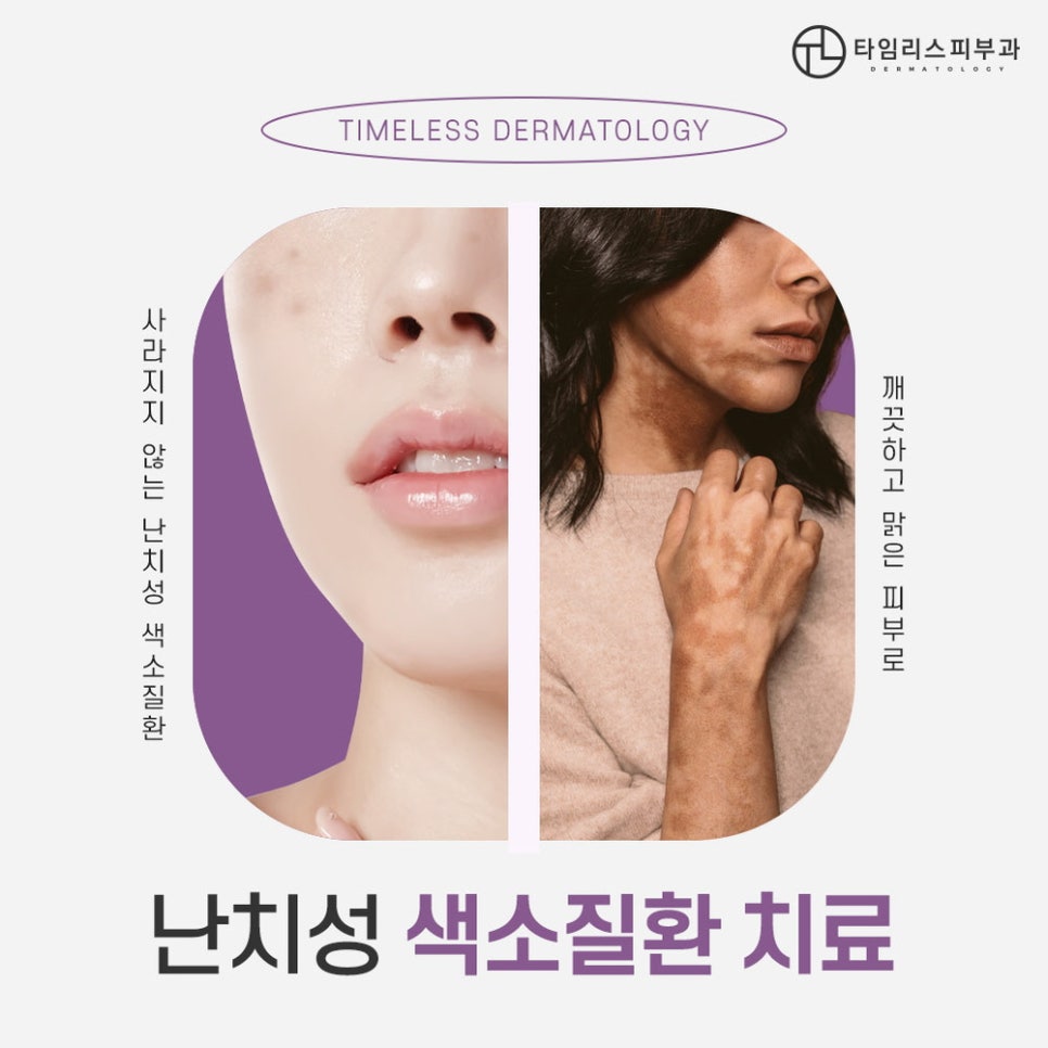 마포피부과 색소침착 적절한 시기에 치료를! 관련 이미지 1