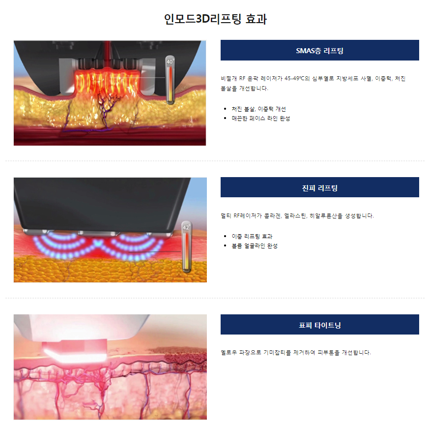 인모드리프팅가격 세번당기고 동안등극 하세요 관련 이미지 4