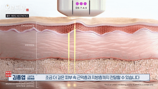 애오개역피부과, 울쎄라 리프팅 볼패임? 걱정된다면 관련 이미지 1
