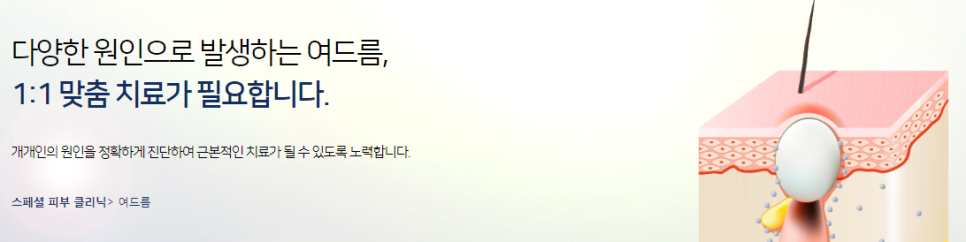 성인여드름치료 타임리스마포에서 카프리로 관리하기 관련 이미지 4